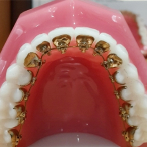 为什么越来越多的人选择牙齿隐形矫正?