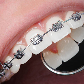 牙周病牙科口腔内的症状有哪些?