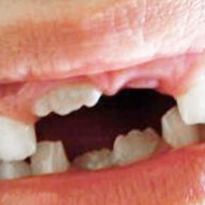 嵌体与补牙有什么区别牙科口腔医院告诉您
